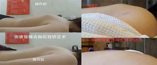 含胸駝背矯正_御唐整骨